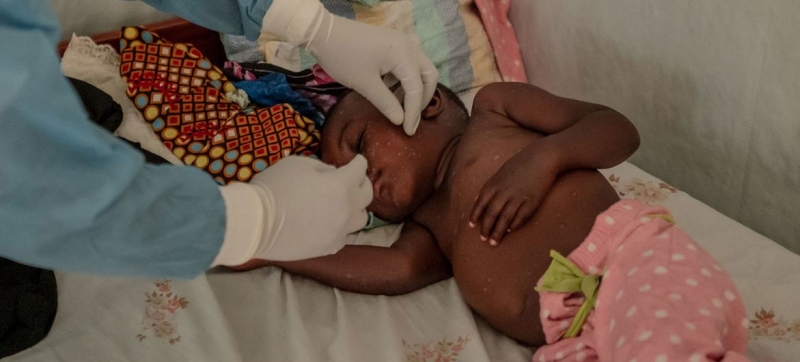 UNICEF: Children are suffering as a result of the spread of monkeypox