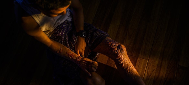 Anti-personnel mines: UN Secretary-General warns of consequences of weakening the Ottawa Convention